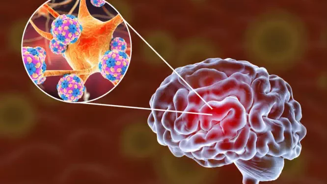 Προσοχή: Η ύπουλη εγκεφαλική ασθένεια που μοιάζει με γρίπη – Συμπτώματα