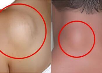 Πως θα ξεφορτωθείτε με φυσικό τρόπο τα λιπώματα