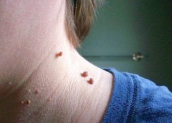 ΑΠΙΣΤΕΥΤΟ!! Δείτε πως μπορείτε εύκολα να εξαφανίσετε αυτές τις μικρές “ελιές”[video]