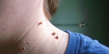 ΑΠΙΣΤΕΥΤΟ!! Δείτε πως μπορείτε εύκολα να εξαφανίσετε αυτές τις μικρές “ελιές”[video]