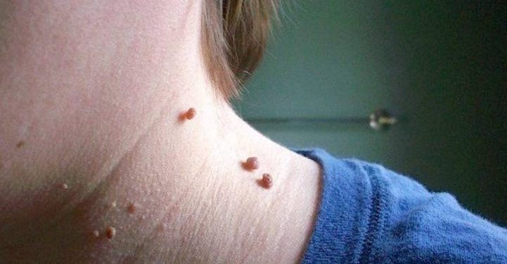 ΑΠΙΣΤΕΥΤΟ!! Δείτε πως μπορείτε εύκολα να εξαφανίσετε αυτές τις μικρές “ελιές”[video]