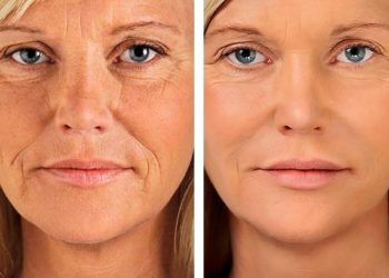 Αυτές είναι οι τέσσερις τροφές που «σβήνουν» τις ρυτίδες!