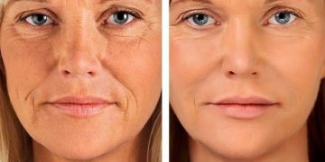 Αυτές είναι οι τέσσερις τροφές που «σβήνουν» τις ρυτίδες!