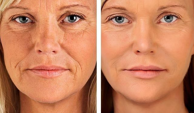 Αυτές είναι οι τέσσερις τροφές που «σβήνουν» τις ρυτίδες!