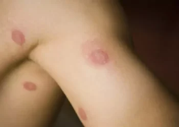 Προσοχή αν δείτε τέτοια σημάδια στο δέρμα σας – Εξαιρετικά μεταδοτική πάθηση