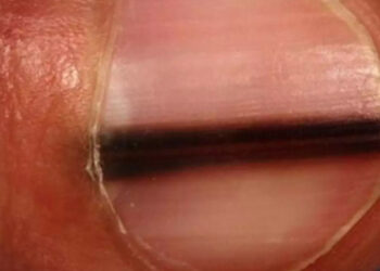 Μεγάλη προσοχή αν δείτε μια μαύρη γραμμή στο νύχι