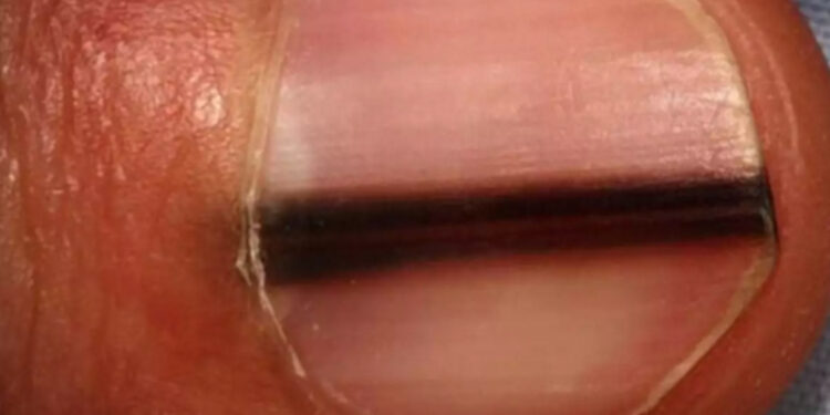 Μεγάλη προσοχή αν δείτε μια μαύρη γραμμή στο νύχι