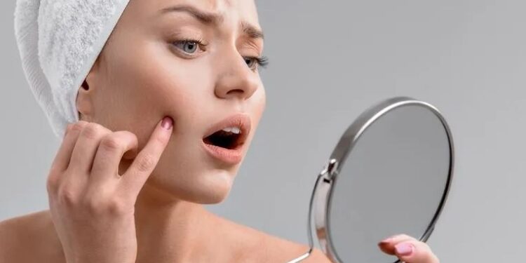 Πώς να εξαφανίσετε ένα σπυράκι με πύον σε 5 απλά βήματα – Κόλπα για να διώξεις τα σπυράκια σου (εικόνες)