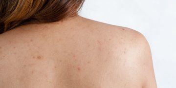 Τι να κάνετε για τα σπυράκια στην πλάτη λόγω ζέστης και ιδρώτα το καλοκαίρι