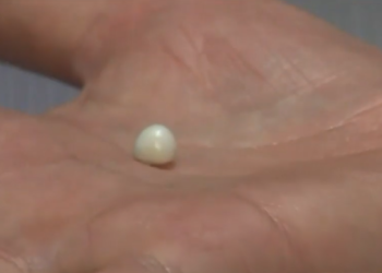 Παρήγγειλε μία μερίδα στρείδια σε εστιατόριο και βρήκε μέσα μαργαριτάρι αξίας 4.000 δολαρίων (pics)