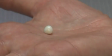 Alldaynews.gr Παρήγγειλε μία μερίδα στρείδια σε εστιατόριο και βρήκε μέσα μαργαριτάρι αξίας 4.000 δολαρίων (pics)