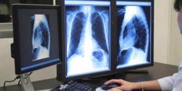 Διέγνωσε “φυσιολογική σπλήνα”, ενώ ο ασθενής την είχε αφαιρέσει!