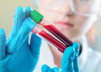 Λευχαιμία: Οι εύκολες μελανιές και τα «ύπουλα» σημάδια στο δέρμα (εικόνες)