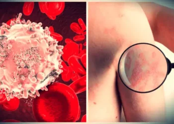 Λευχαιμία: Οι εύκολες μελανιές και τα «ύπουλα» σημάδια στο δέρμα (εικόνες)