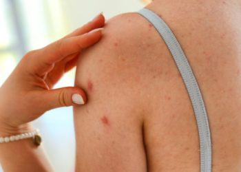 Τι σημαίνει αν έχετε μια ελιά που “σας τρώει” – Πότε η φαγούρα είναι καρκίνος του δέρματος