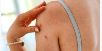 Τι σημαίνει αν έχετε μια ελιά που “σας τρώει” – Πότε η φαγούρα είναι καρκίνος του δέρματος