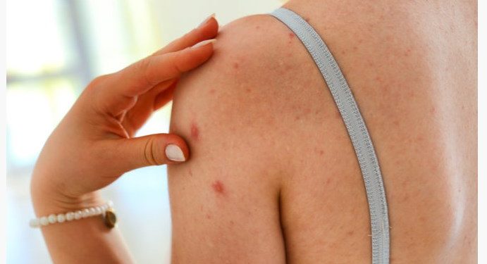 Τι σημαίνει αν έχετε μια ελιά που “σας τρώει” – Πότε η φαγούρα είναι καρκίνος του δέρματος