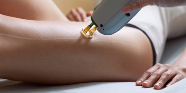 Alldaynews.gr Αποτρίχωση με λέιζερ: Οι παρενέργειες στο δέρμα – Δείτε πώς γίνεται (Videos)