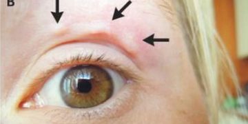 Alldaynews.gr Βλέπετε ΑΥΤΟ το περίεργο “εξόγκωμα” στο μάτι της; Ήταν σκουλήκι που σερνόταν κάτω από το δέρμα!