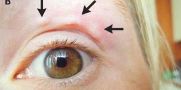 Alldaynews.gr Βλέπετε ΑΥΤΟ το περίεργο “εξόγκωμα” στο μάτι της; Ήταν σκουλήκι που σερνόταν κάτω από το δέρμα!