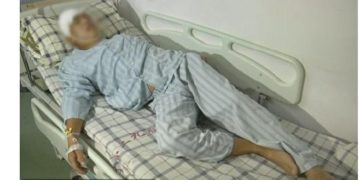 Σκουλήκι ζούσε και έτρωγε τον εγκέφαλο του επί 15 χρόνια – Το έπαθε επειδή έτρωγε πολλά…[photos]