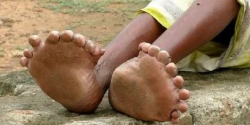 Γυναίκα έχει 19 δάχτυλα στα πόδια και 12 στα χέρια! Είναι Μάγισσα λένε..[photos][video]