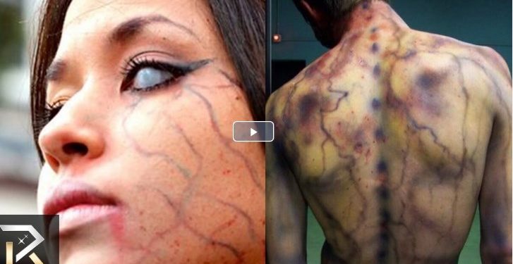 Απίστευτο κι όμως αληθινό: Δείτε τι απέγιναν όσοι χτυπήθηκαν από κεραυνό[video]