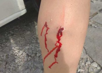 Αδέσποτο σκυλί δάγκωσε 10χρονο παιδί στο πόδι στην αυλή του Γυμνασίου “Αρρένων”