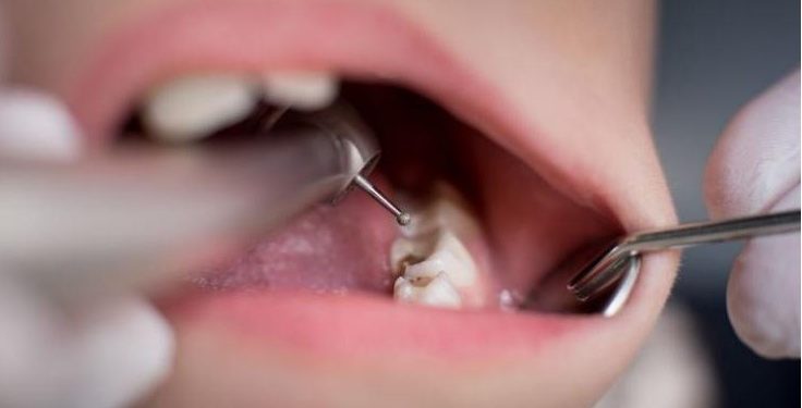 Έπαθε ΣΟΚ ο οδοντίατρος!! Έβγαλε το μακρύτερο δόντι που έχει βρεθεί ποτέ σε άνθρωπο![photos]