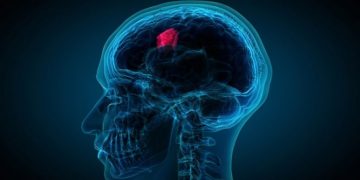 Alldaynews.gr Όγκος στο κεφάλι: Πώς θα τον καταλάβετε – Ποιοι κινδυνεύουν