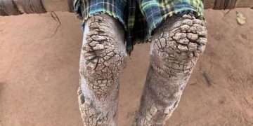 7χρονο κοριτσάκι μετατρέπεται σε πέτρα-Σοκαριστικές Εικόνες