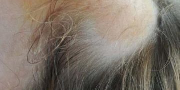 Alldaynews.gr Σοκαριστικό ατύχημα σε νηπιαγωγείο! Ξεριζώθηκαν τα μαλλιά 5χρονης (pics)