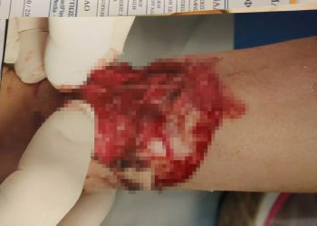 Πρέβεζα: Σκύλος δάγκωσε και τραυμάτισε σοβαρά μια 9χρονη! Σκληρές εικόνες