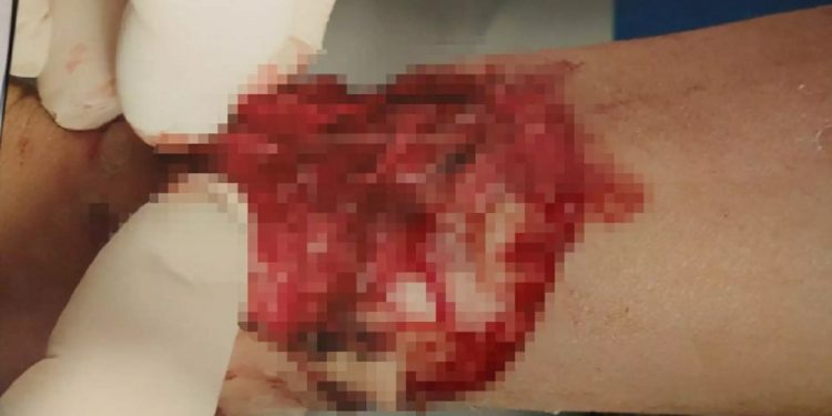 Alldaynews.gr Πρέβεζα: Σκύλος δάγκωσε και τραυμάτισε σοβαρά μια 9χρονη! Σκληρές εικόνες