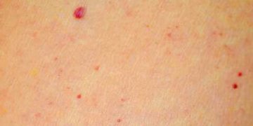 Alldaynews.gr Κόκκινες ελιές στο δέρμα: Πότε βγαίνουν, ποιοι τύποι υπάρχουν και τι να προσέχετε