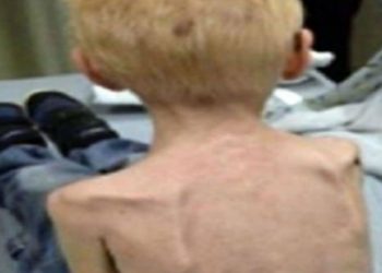 Τραγικό! H αστυνομία βρήκε ένα 5χρονο που ήταν τόσο υποσιτισμένος που έτρωγε το δικό του χέρι