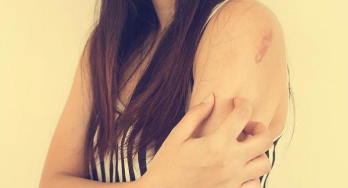 Ακόμα μία αρνητική επίπτωση του κορωνοϊού στον οργανισμό: Επιδεινώνει την ατοπική δερματίτιδα