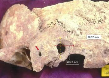 Θάσος: Σπουδαία ανακάλυψη με ίχνη πολύπλοκης χειρουργικής επέμβασης σε ανθρώπινο κρανίο!