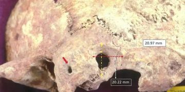 Alldaynews.gr Θάσος: Σπουδαία ανακάλυψη με ίχνη πολύπλοκης χειρουργικής επέμβασης σε ανθρώπινο κρανίο!