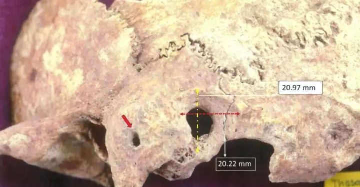 Alldaynews.gr Θάσος: Σπουδαία ανακάλυψη με ίχνη πολύπλοκης χειρουργικής επέμβασης σε ανθρώπινο κρανίο!