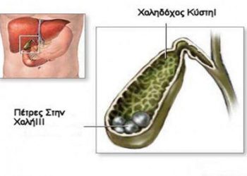 Πόνος στη Χολή: Τι μπορεί να σημαίνει;
