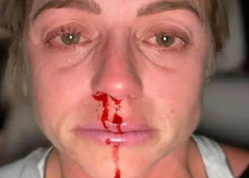 «Μαύρες» από το ξύλο στην καραντίνα – Γυναίκες δείχνουν το μελανιασμένο πρόσωπό τους