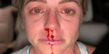 Alldaynews.gr «Μαύρες» από το ξύλο στην καραντίνα – Γυναίκες δείχνουν το μελανιασμένο πρόσωπό τους