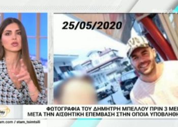 Ο Μπέλλος έκανε εμφύτευση μαλλιών