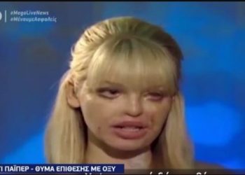 Επίθεση με βιτριόλι: Η επίθεση με οξύ στην 24χρονη-Τα 40 χειρουργεία και ο Γολγοθάς[video]