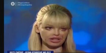 Επίθεση με βιτριόλι: Η επίθεση με οξύ στην 24χρονη-Τα 40 χειρουργεία και ο Γολγοθάς[video]