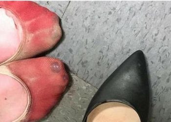 Τα καταματωμένα πόδια μιας σερβιτόρας από τα τακούνια στην πιο viral φωτογραφία