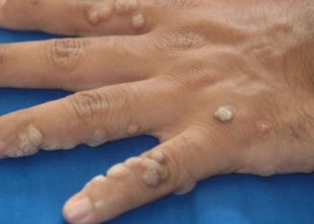 Οι μυρμηγκιές κολλάνε; Είναι ΗPV; Ποιοι κινδυνεύουν και πώς αντιμετωπίζονται;