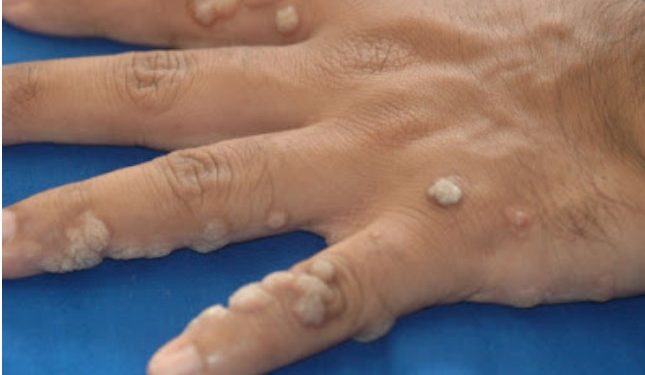 Alldaynews.gr Οι μυρμηγκιές κολλάνε; Είναι ΗPV; Ποιοι κινδυνεύουν και πώς αντιμετωπίζονται;