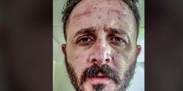 Alldaynews.gr Καταπέλτης γιατρός του ΠΑΓΝΗ: Γκρινιάζετε για τις μάσκες κι εμείς δεν έχουμε!